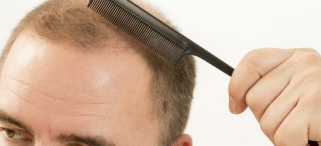 The Appeal of Undergoing Professional Hair Transplant in New York City