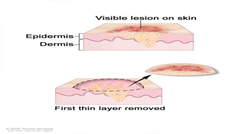 Eczema Treatment in Maple Grove, MN: When to Seek Help