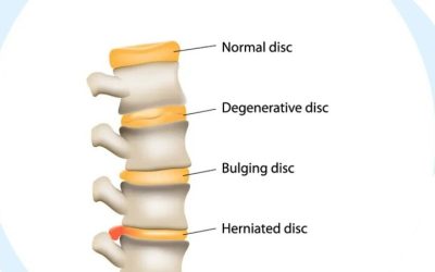 Why Can Disc-Related Back Symptoms Feel Worse First Thing in the Morning?